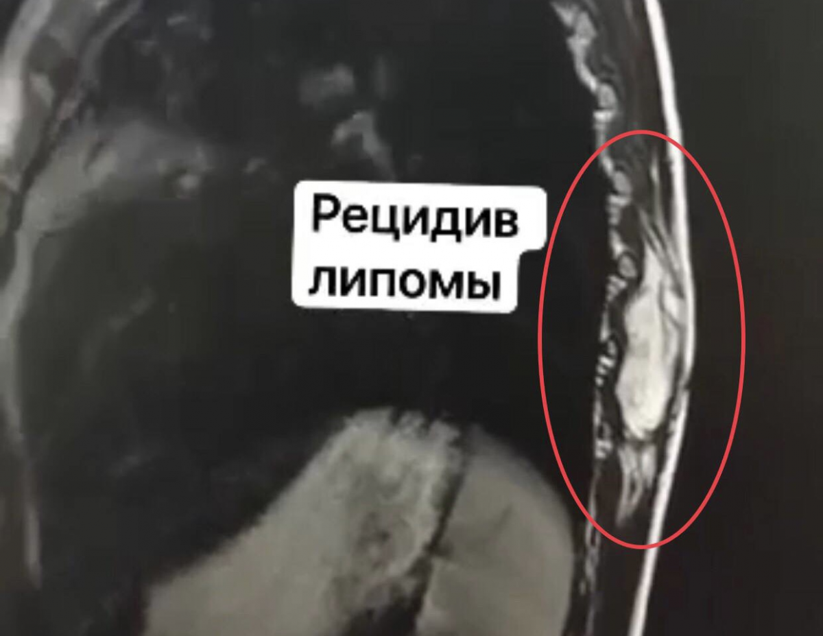Видновские врачи спасли ребенка с опасным новообразованием спины